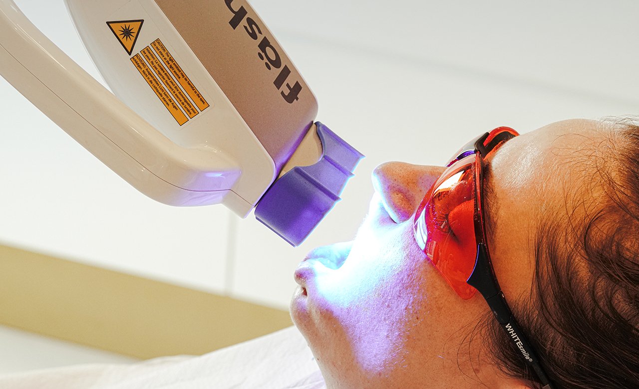 laser bleaching teeth whitening