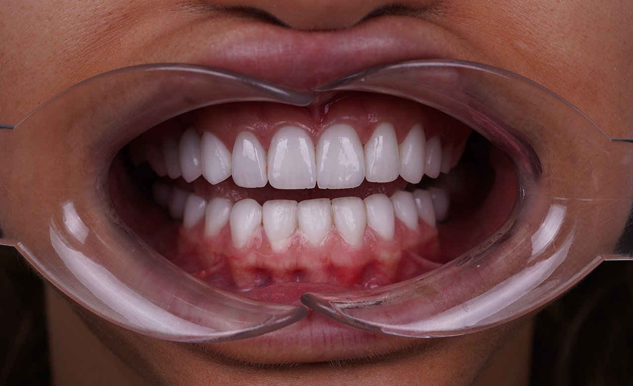 Smile Makeover in Turkey