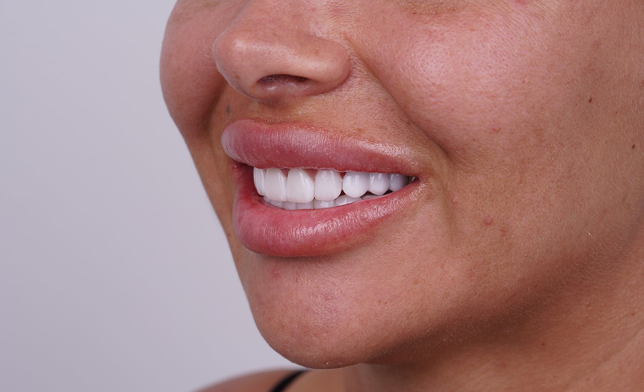 Smile Makeover in Turkey