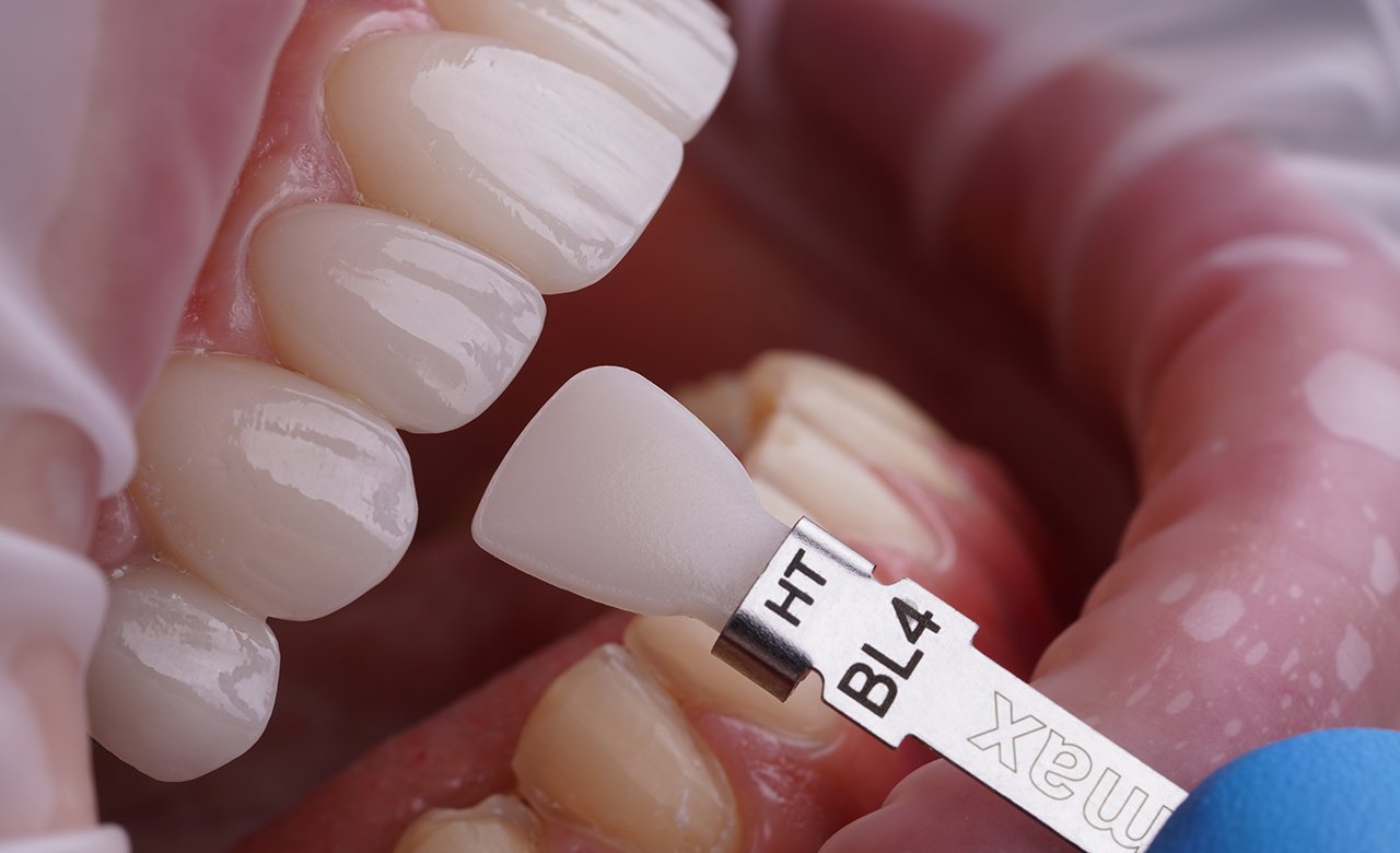 Smile Makeover in Turkey