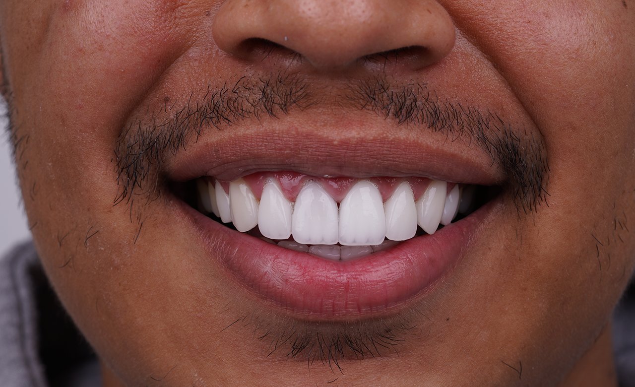 Smile Makeover in Turkey