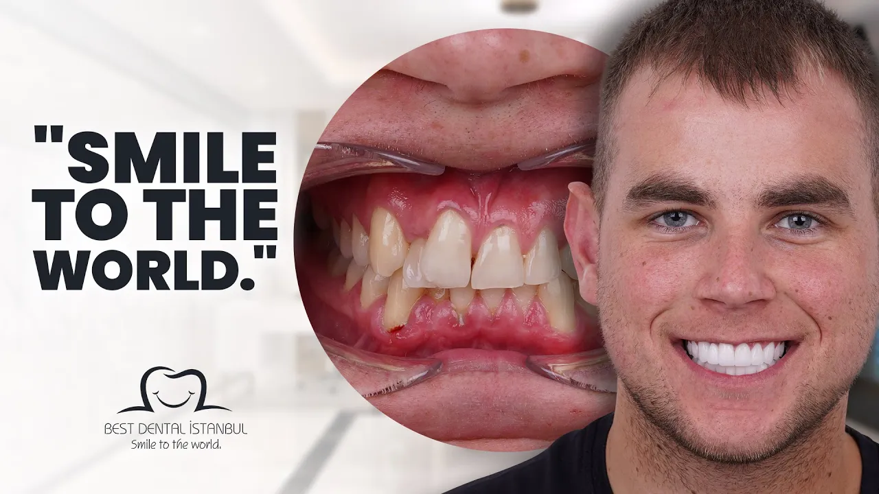 Smile Makeover in Turkey