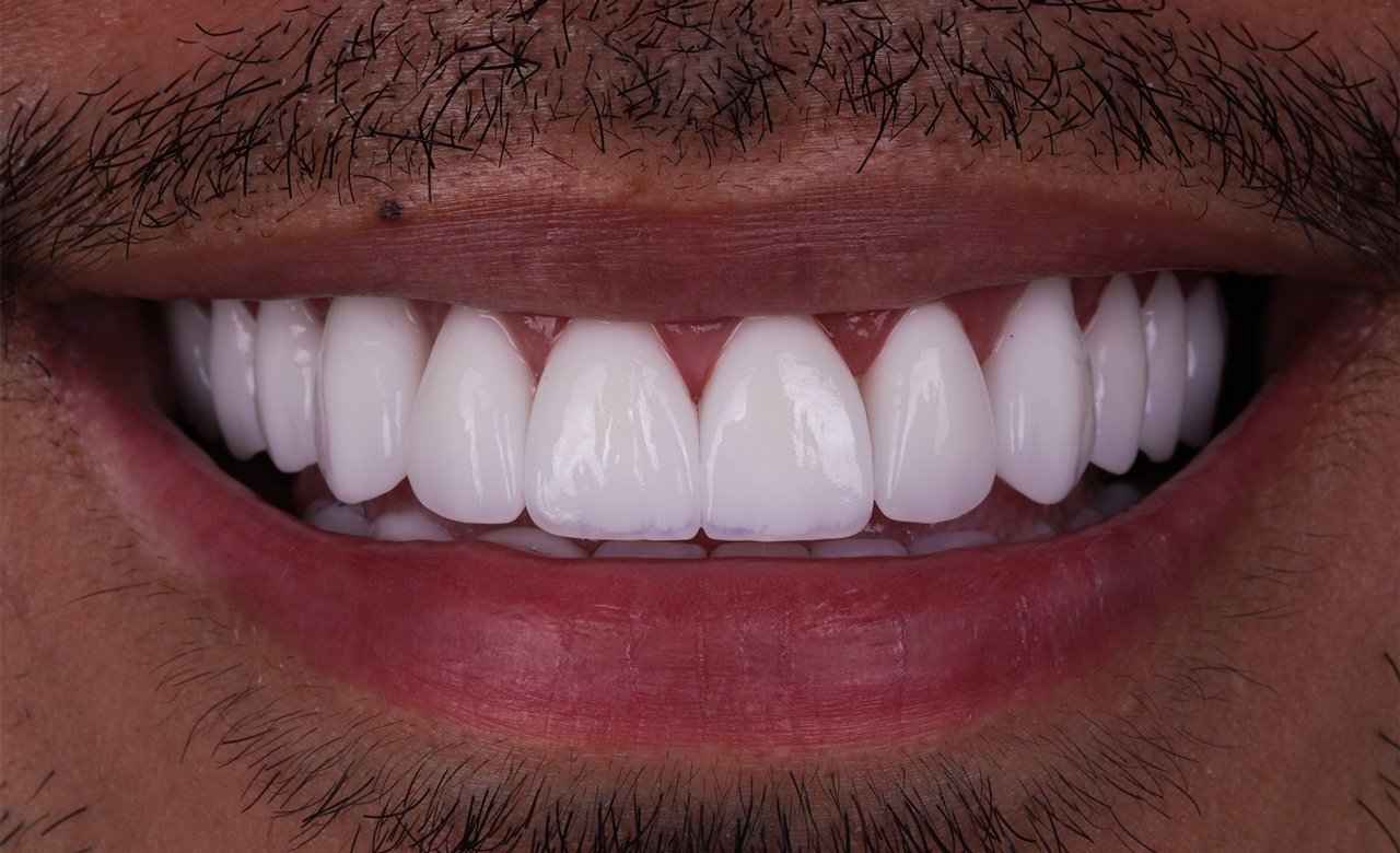 zirconium crowns images in turkey
