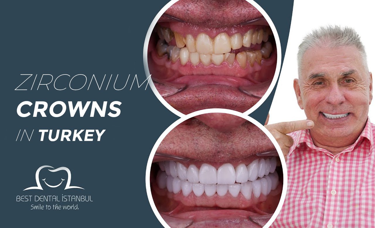 Zirconium Crowns in Turkey