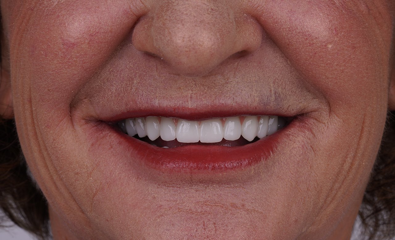 zirconium crowns on dental implant in turkey