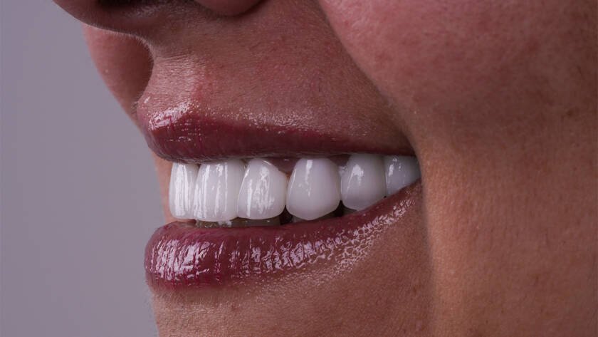 zirconium crowns treatments