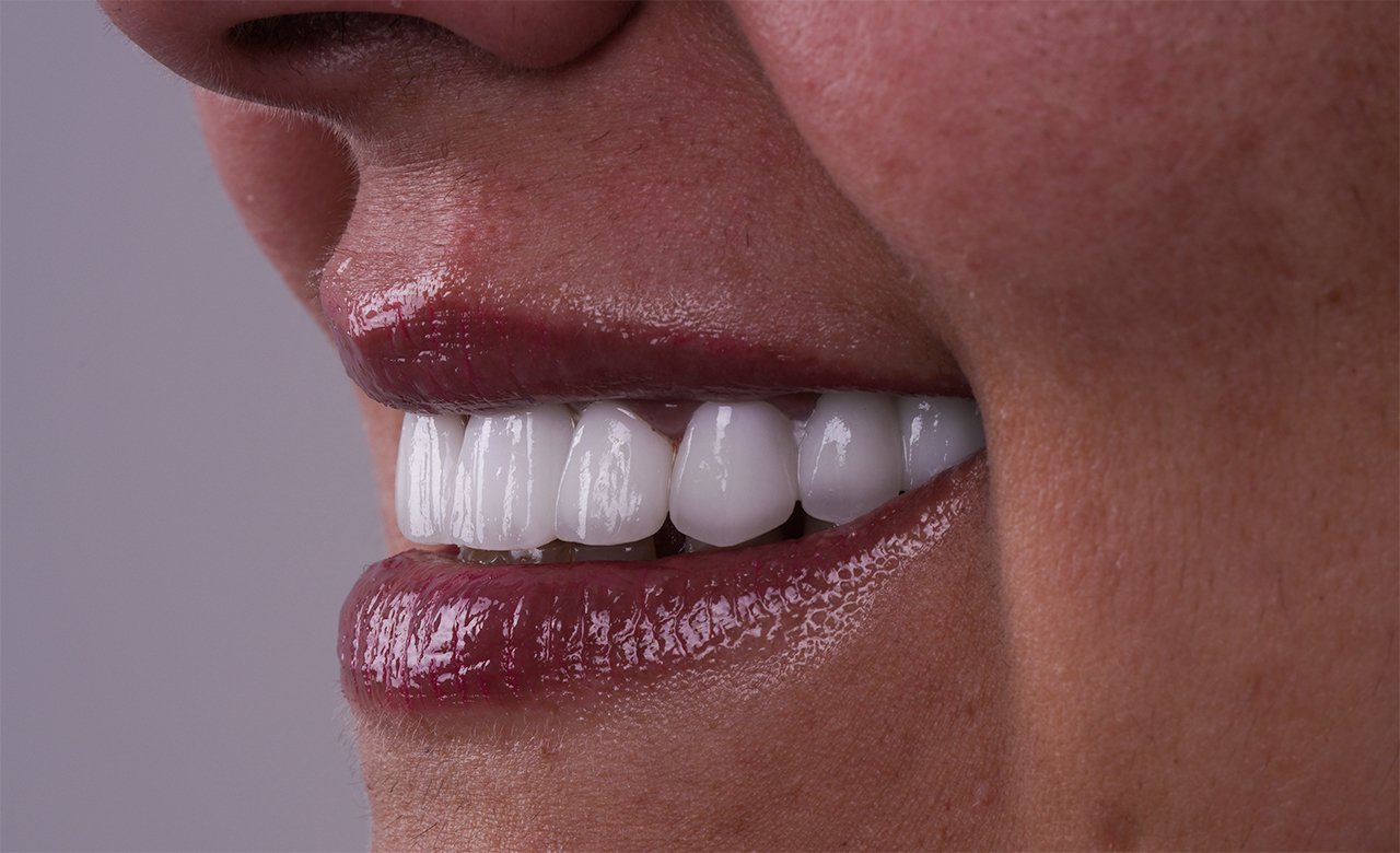zirconium crowns treatments