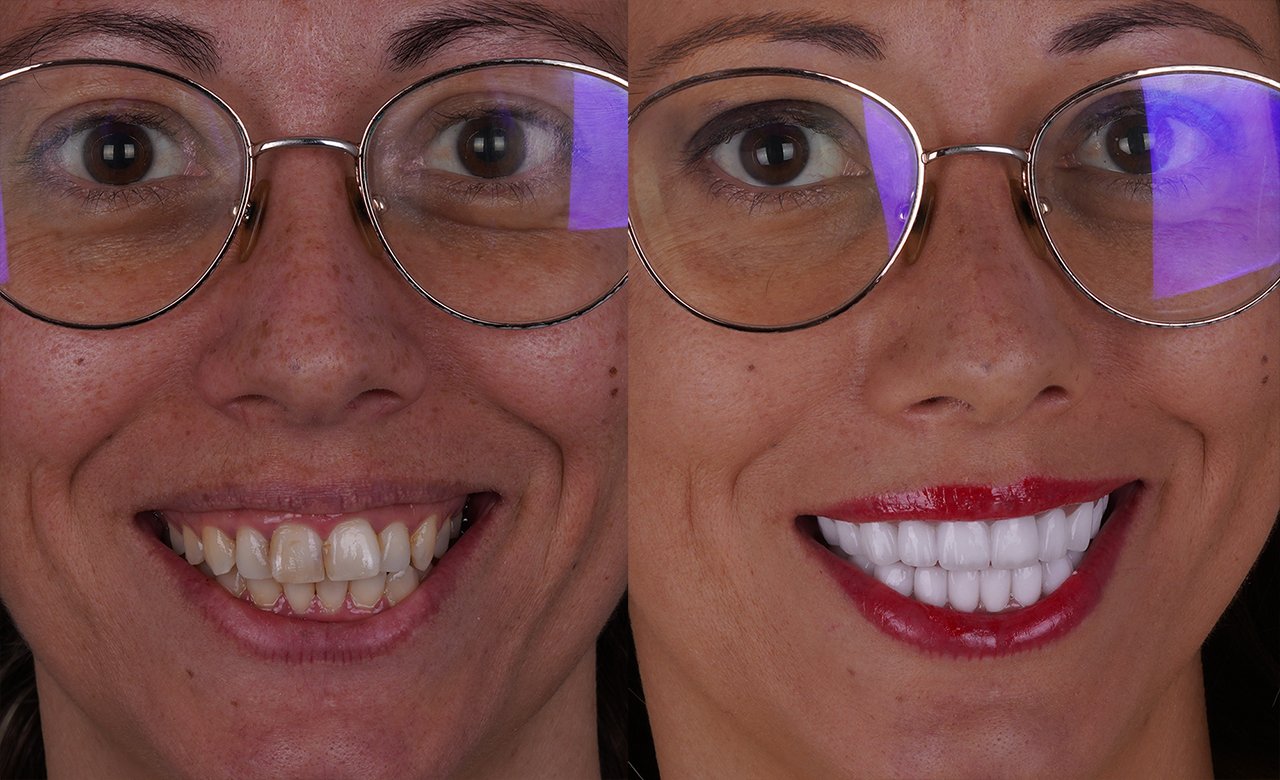 zirconium crowns turkiye