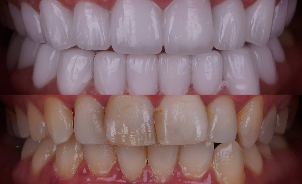 zirconium teeth turkey