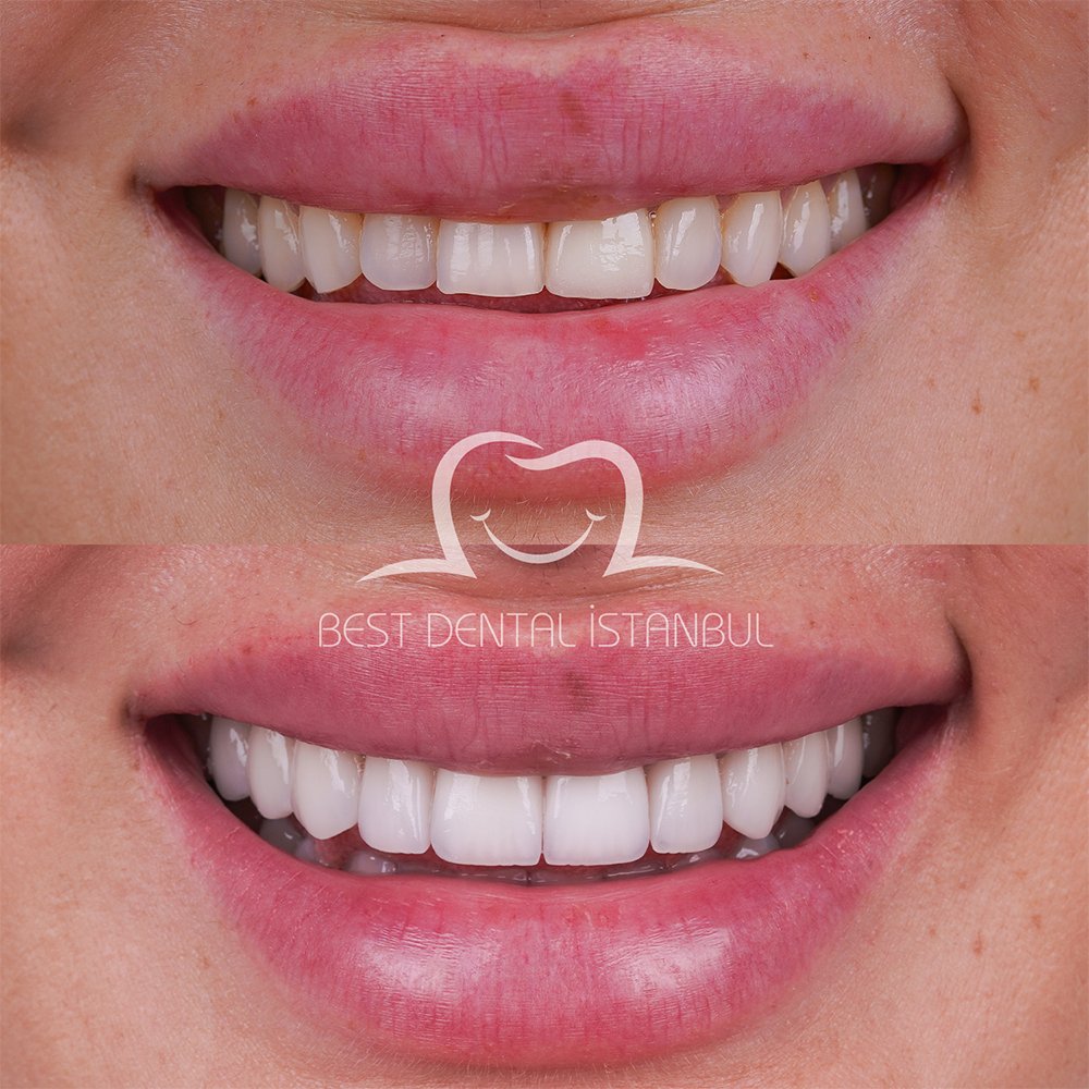 Before and After Photo of Dental Lumineers in Turkey