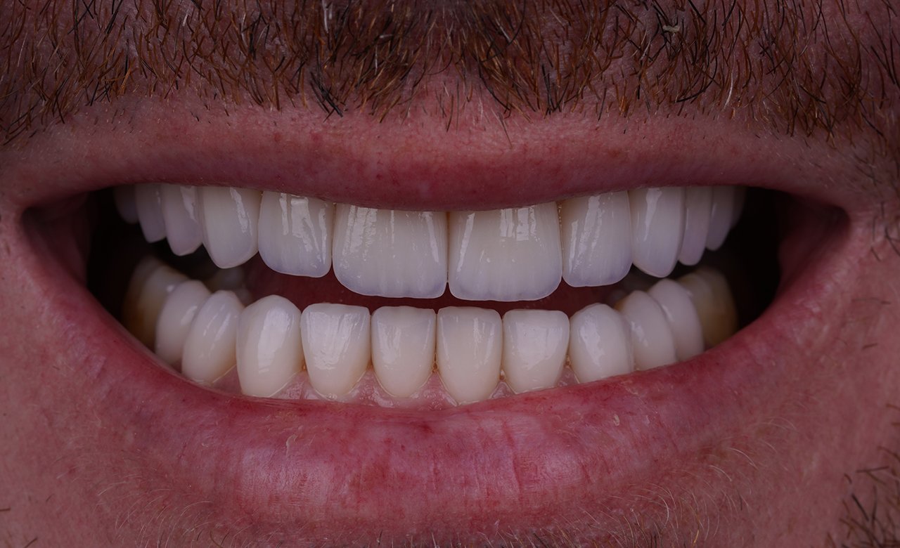 Dental Lumineers Treatments