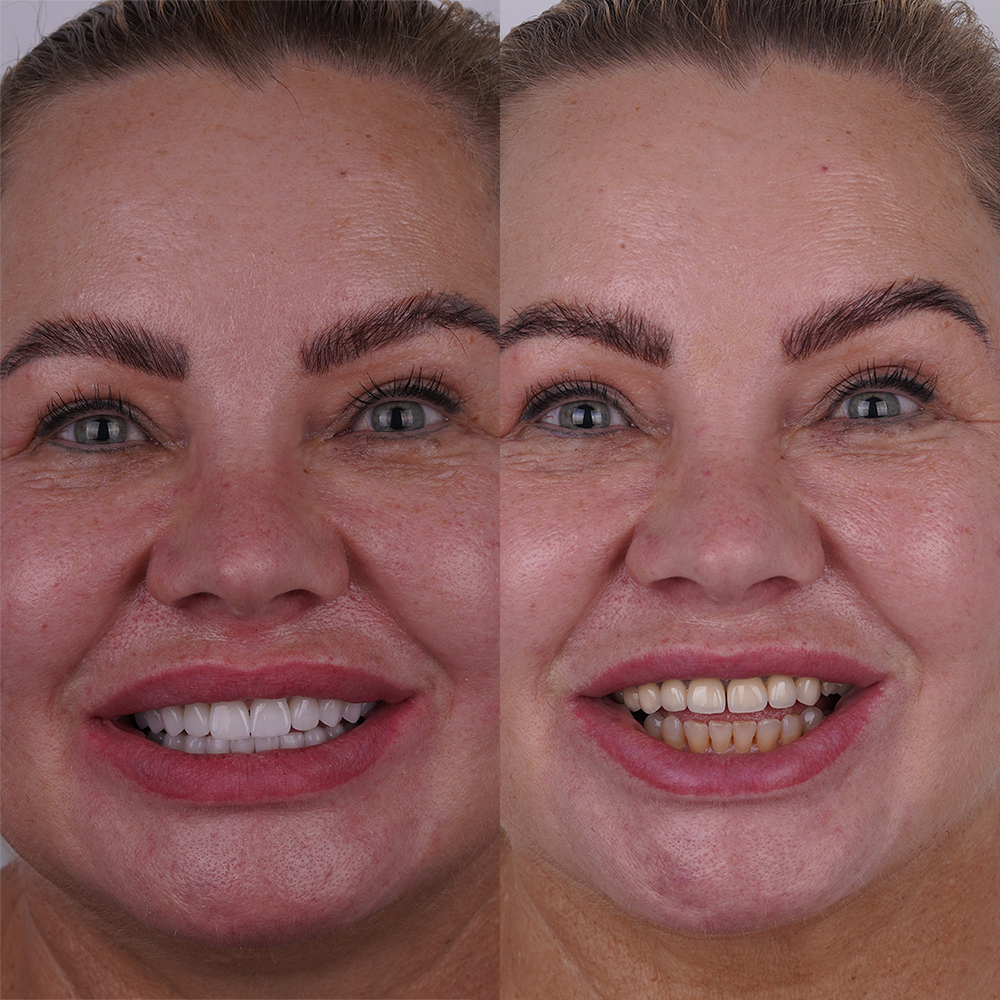 before and after pictures of zirconium crowns in turkey