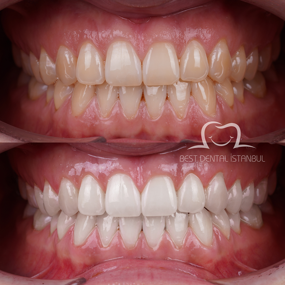 Teeth Whitening Turkey