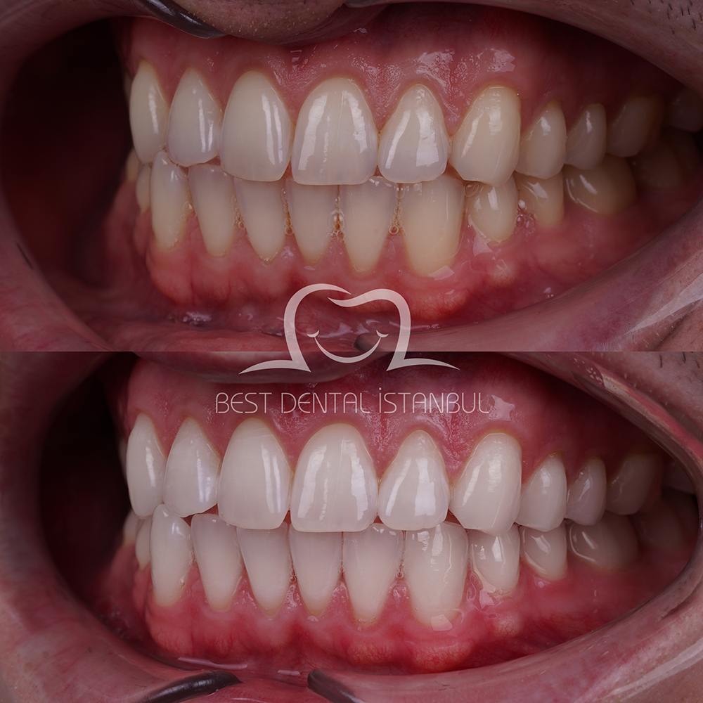 Teeth Whitening in Turkey