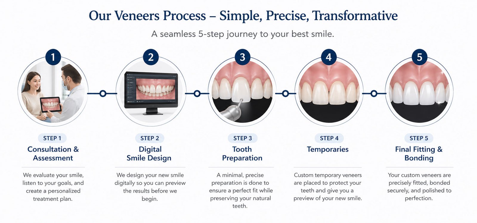 The Veneer Process Step by Step