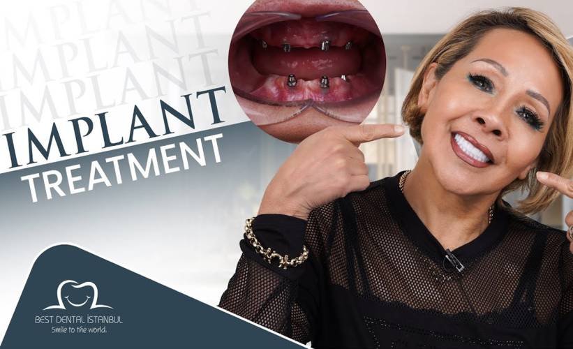 Dental Implants in Turkey