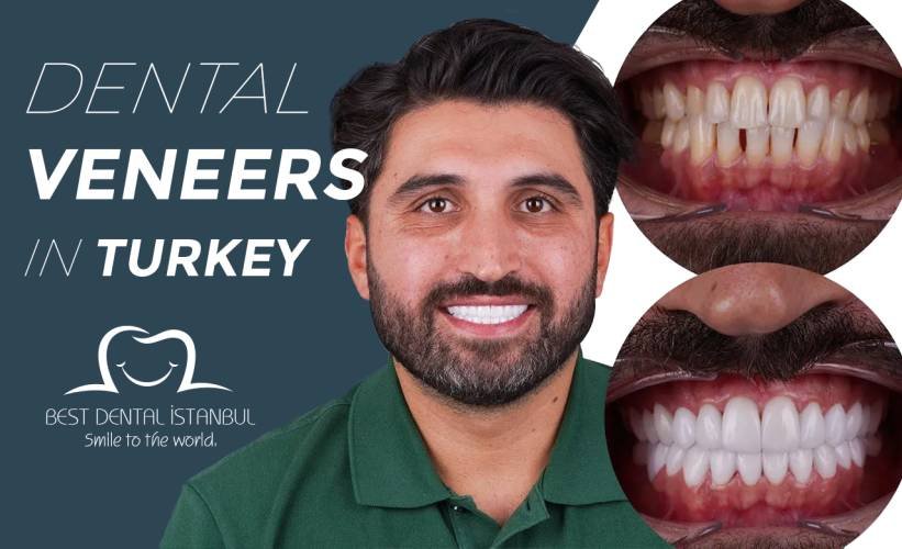 Dental Veneers in Turkey