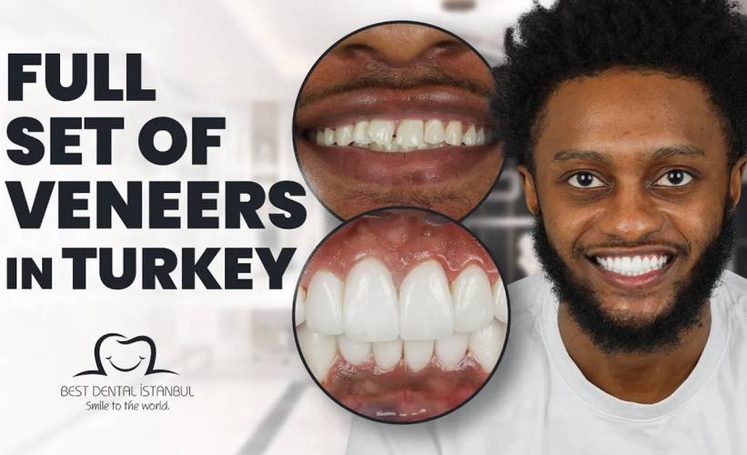 Full Set of Veneers in Turkey