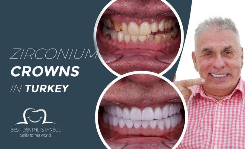 Zirconium Crowns in Turkey